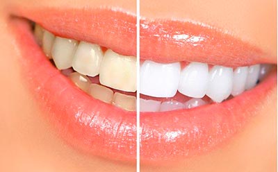 ультразвукавая чистка зубов